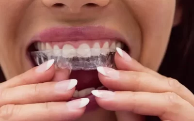 Invisalign Indianapolis: Clear Aligner Therapy for Discreet Orthodontic Correction